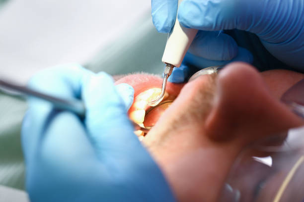 Best Emergency Root Canal Treatment in University Park, TX
